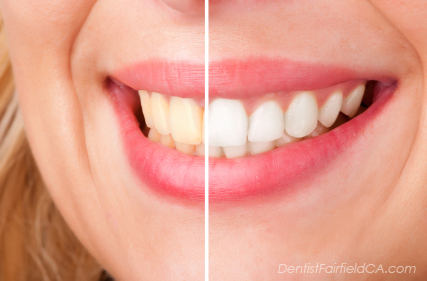 What You Need to Know About Teeth Whitening