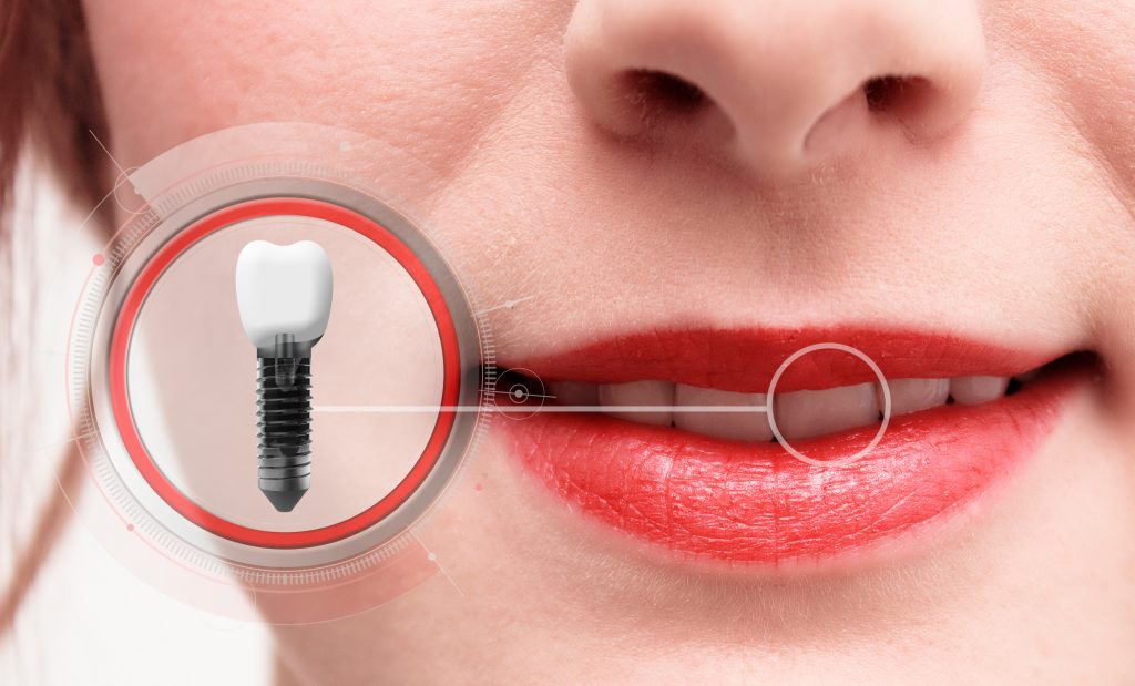 What are Dental Implants?