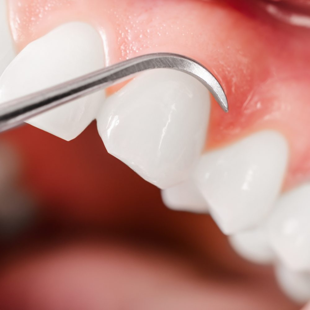 Cavities- What They are and What They do