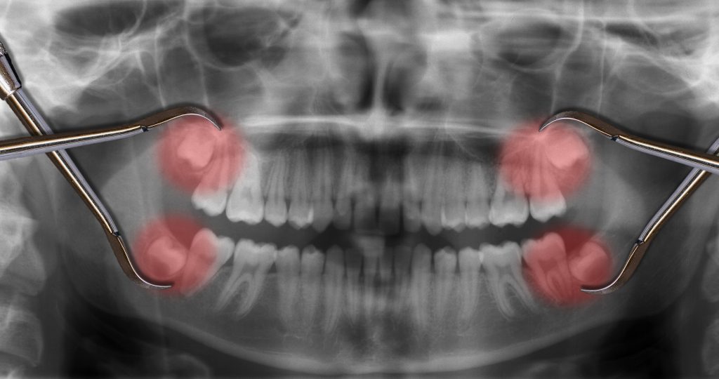 Wisdom Teeth: To Keep or Not to Keep?