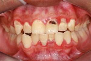 Gum Disease and Covid-19 Severity